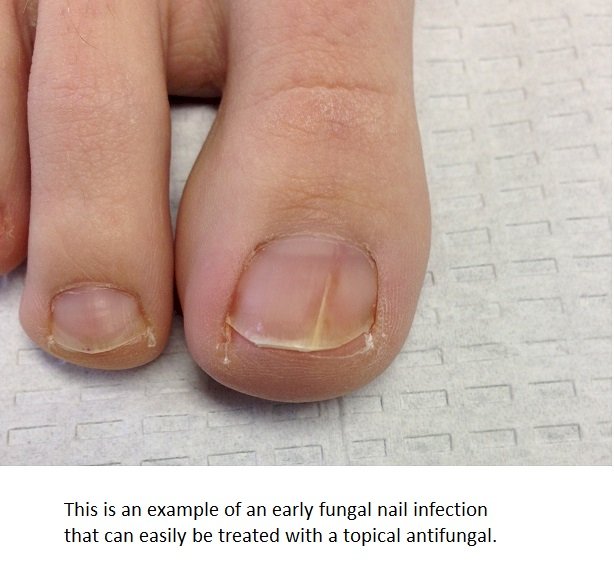 early stage fungal infection of a toe nail